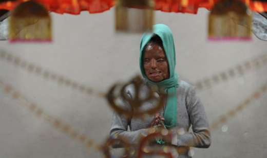 Acid attack victim-KBC winner